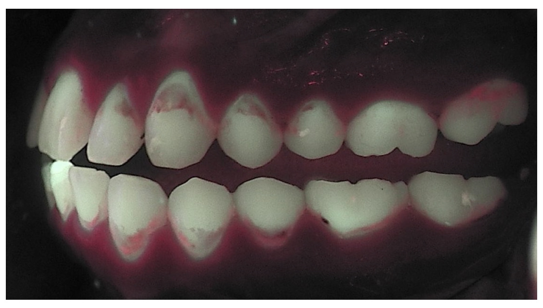 oral qamera foto van gebit met tandplak publicaties